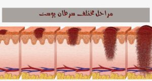 شناخت علائم سرطان پوست: راهنمایی جامع برای تشخیص زودرس