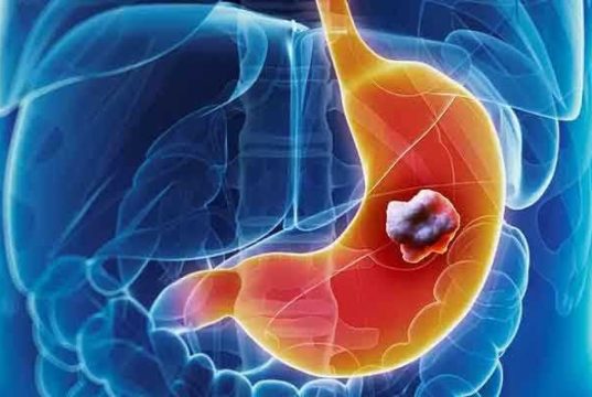سرطان معده: پنج نشانه که نباید نادیده گرفته شوند