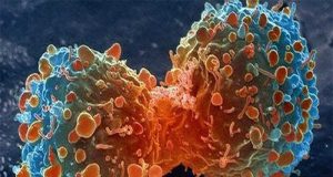 پنج راه ساده برای پیشگیری از سرطان روده بزرگ