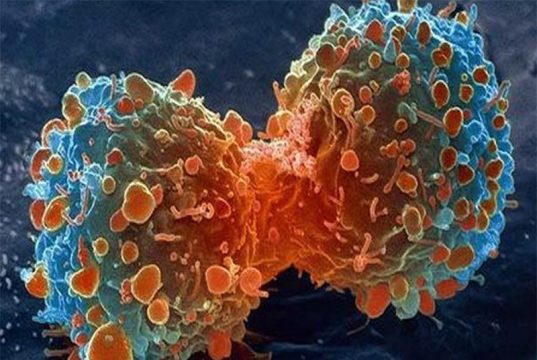 پنج راه ساده برای پیشگیری از سرطان روده بزرگ